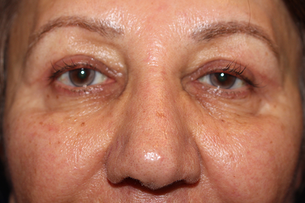 Eyelid Surgery Case 40848 After Photo Eyelid Surgery