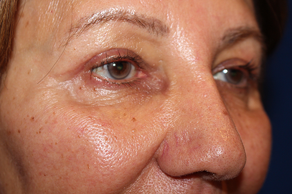 Eyelid Surgery Case 40848 After Photo Eyelid Surgery