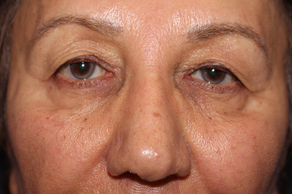 Eyelid Surgery Case 40848 Before Photo Eyelid Surgery