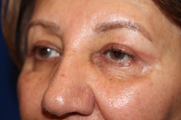 Eyelid Surgery Case 40848 After Photo Eyelid Surgery