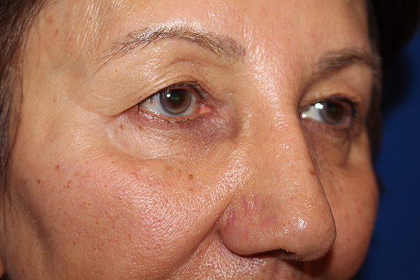 Eyelid Surgery Case 40848 Before Photo Eyelid Surgery