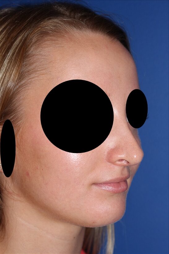 Rhinoplasty - Nasal Reshaping Case 41575 After Photo Rhinoplasty - Nasal Reshaping