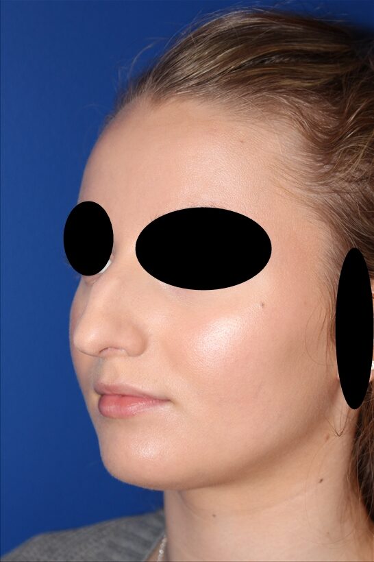 Rhinoplasty - Nasal Reshaping Case 41575 Before Photo Rhinoplasty - Nasal Reshaping