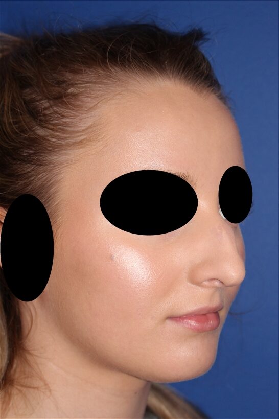 Rhinoplasty - Nasal Reshaping Case 41575 Before Photo Rhinoplasty - Nasal Reshaping