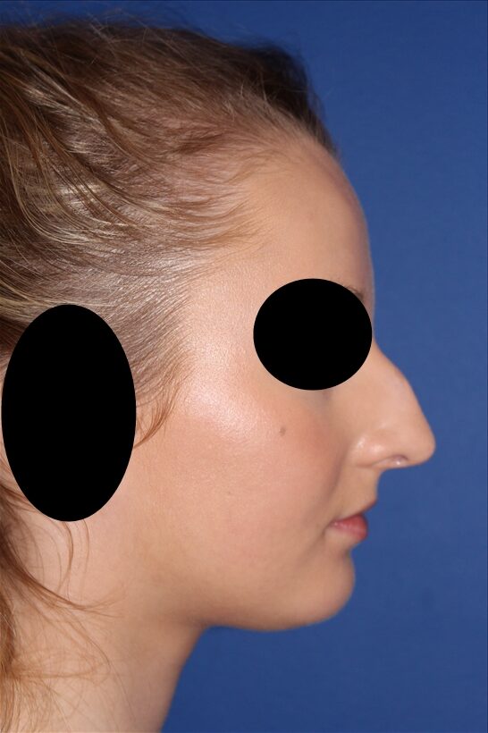 Rhinoplasty - Nasal Reshaping Case 41575 Before Photo Rhinoplasty - Nasal Reshaping