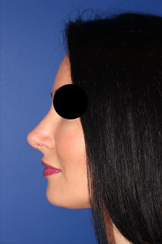Rhinoplasty - Nasal Reshaping Case 41694 After Photo Rhinoplasty - Nasal Reshaping