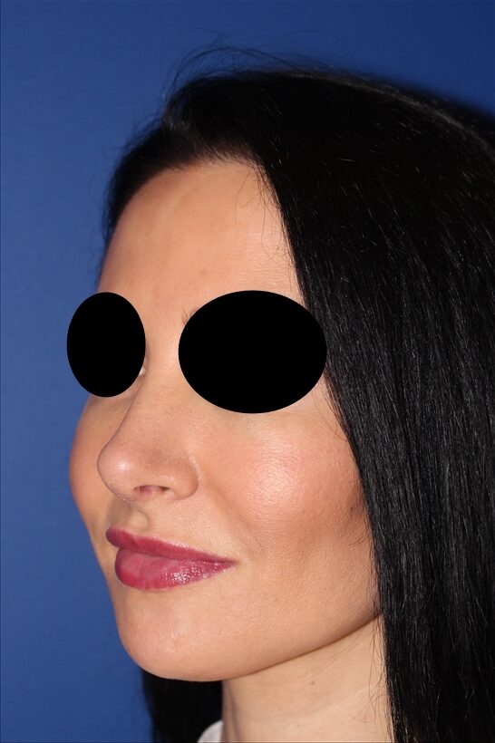 Rhinoplasty - Nasal Reshaping Case 41694 After Photo Rhinoplasty - Nasal Reshaping