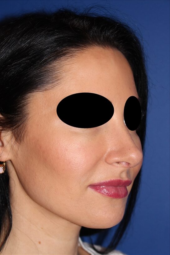 Rhinoplasty - Nasal Reshaping Case 41694 After Photo Rhinoplasty - Nasal Reshaping