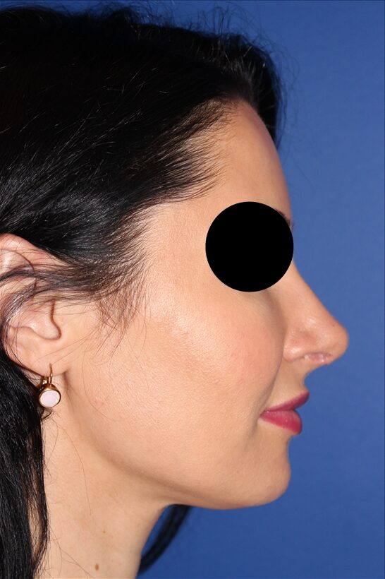 Rhinoplasty - Nasal Reshaping Case 41694 After Photo Rhinoplasty - Nasal Reshaping