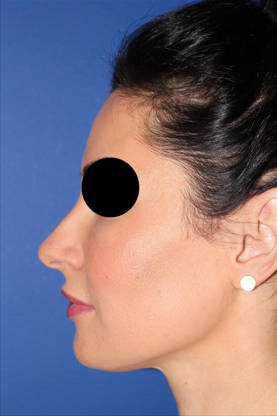 Rhinoplasty - Nasal Reshaping Case 41694 Before Photo Rhinoplasty - Nasal Reshaping