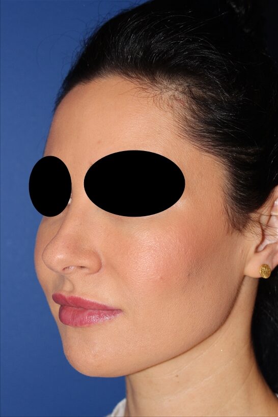 Rhinoplasty - Nasal Reshaping Case 41694 Before Photo Rhinoplasty - Nasal Reshaping