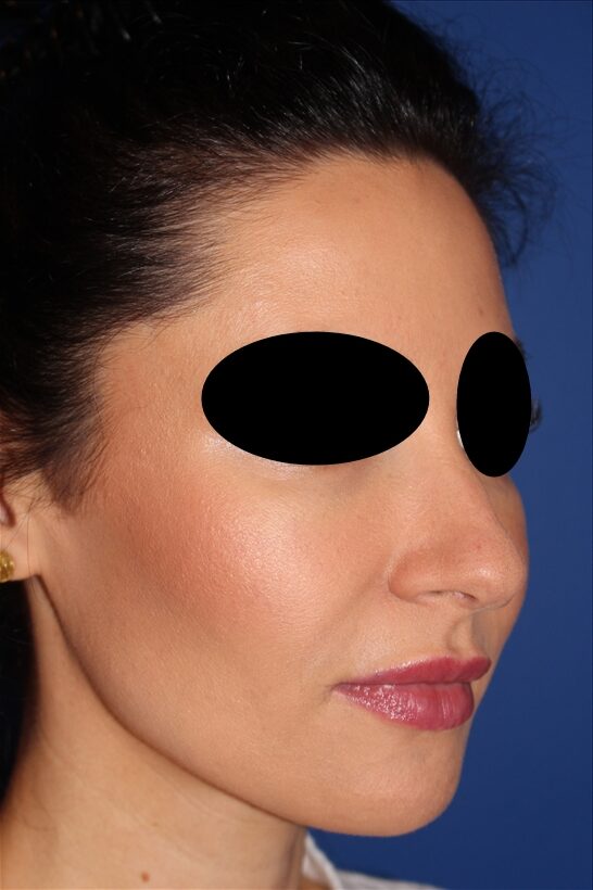 Rhinoplasty - Nasal Reshaping Case 41694 Before Photo Rhinoplasty - Nasal Reshaping