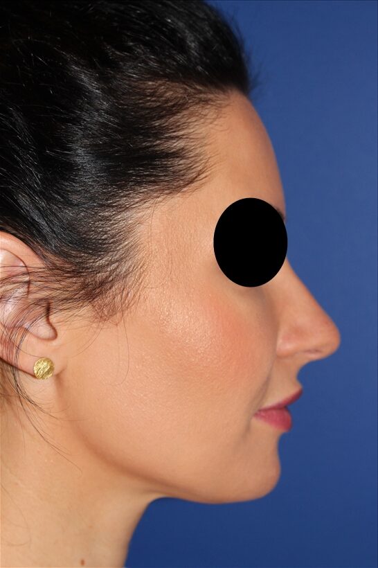 Rhinoplasty - Nasal Reshaping Case 41694 Before Photo Rhinoplasty - Nasal Reshaping
