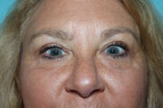 Eyelid Surgery