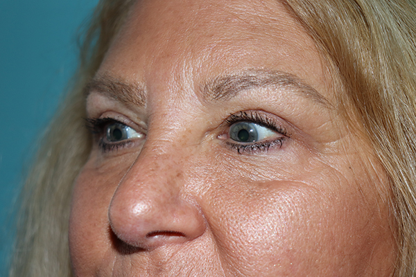 Eyelid Surgery Case 43664 After Photo Eyelid Surgery