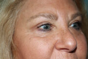 Eyelid Surgery