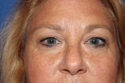 Eyelid Surgery