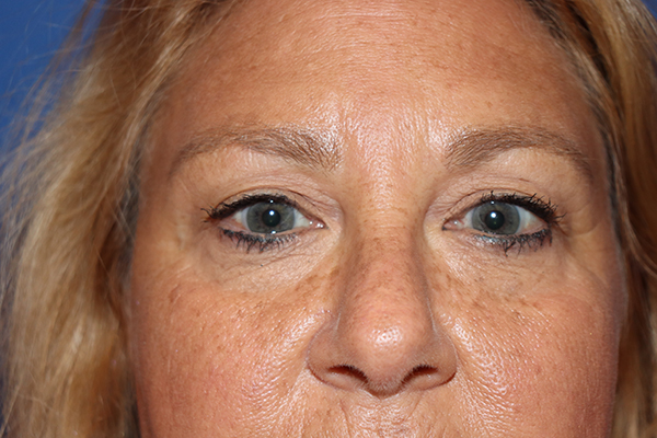 Eyelid Surgery Case 43664 Before Photo Eyelid Surgery