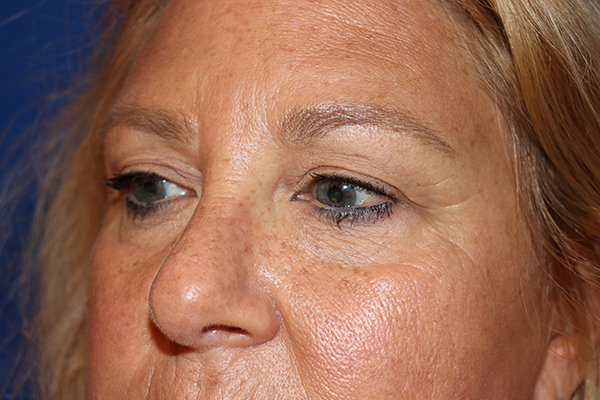 Eyelid Surgery Case 43664 Before Photo Eyelid Surgery