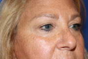 Eyelid Surgery