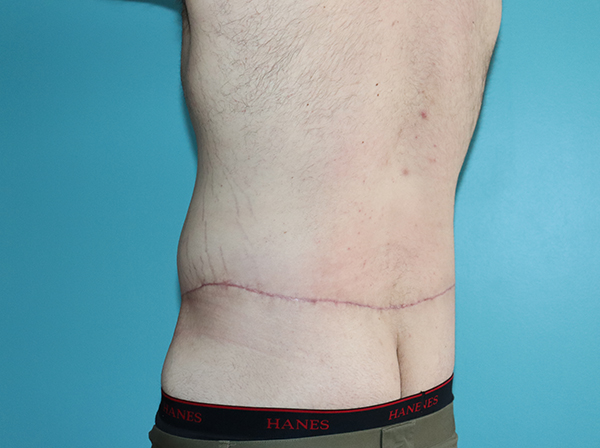Body Contouring After Major Weight Loss Case 43998 After Photo Body Contouring After Major Weight Loss