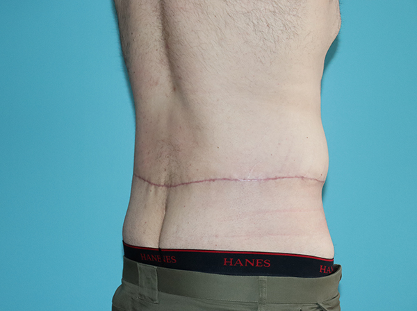 Body Contouring After Major Weight Loss Case 43998 After Photo Body Contouring After Major Weight Loss