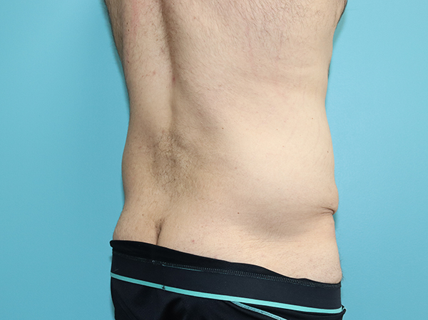 Body Contouring After Major Weight Loss Case 43998 Before Photo Body Contouring After Major Weight Loss