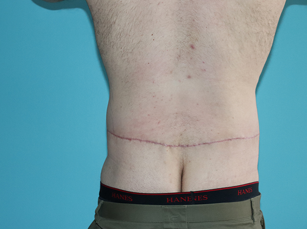 Body Contouring After Major Weight Loss Case 43998 After Photo Body Contouring After Major Weight Loss