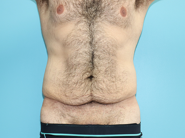 Body Contouring After Major Weight Loss Case 43998 Before Photo Body Contouring After Major Weight Loss
