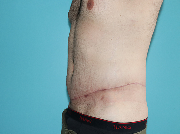 Body Contouring After Major Weight Loss Case 43998 After Photo Body Contouring After Major Weight Loss