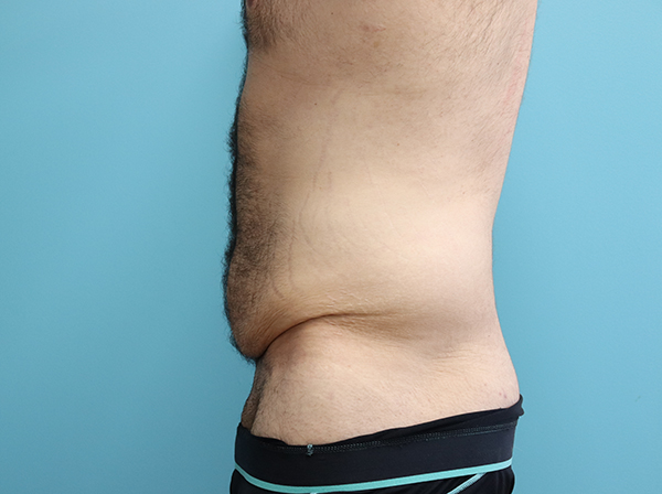 Body Contouring After Major Weight Loss Case 43998 Before Photo Body Contouring After Major Weight Loss