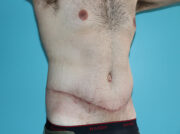 Body Contouring After Major Weight Loss