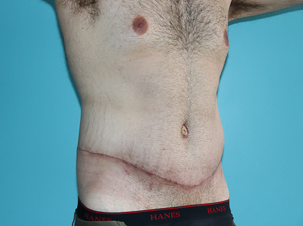 Body Contouring After Major Weight Loss Case 43998 After Photo Body Contouring After Major Weight Loss
