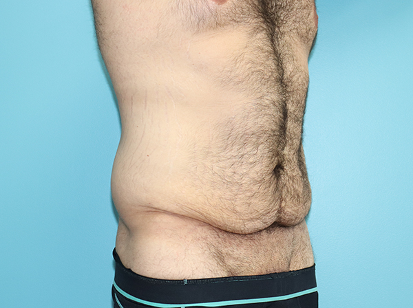 Body Contouring After Major Weight Loss Case 43998 Before Photo Body Contouring After Major Weight Loss