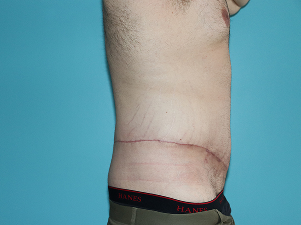 Body Contouring After Major Weight Loss Case 43998 After Photo Body Contouring After Major Weight Loss