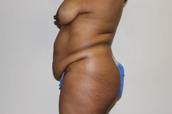 Tummy Tuck Case 44242 Before Photo Tummy Tuck