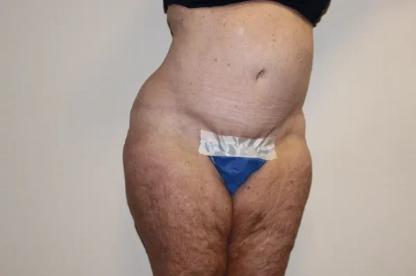 Tummy Tuck Case 44264 After Photo Tummy Tuck