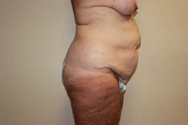 Tummy Tuck Case 44264 Before Photo Tummy Tuck