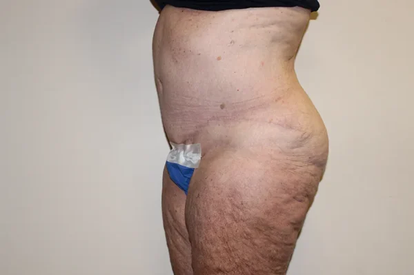 Tummy Tuck Case 44264 After Photo Tummy Tuck