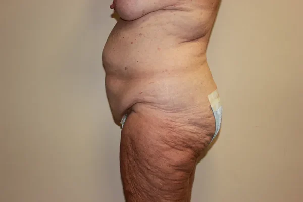 Tummy Tuck Case 44264 Before Photo Tummy Tuck