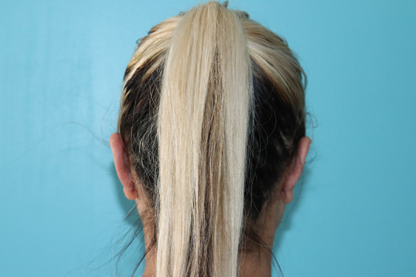 Ear Reshaping - Otoplasty