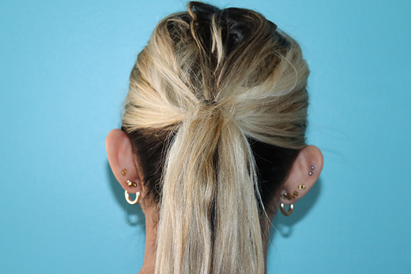 Ear Reshaping - Otoplasty