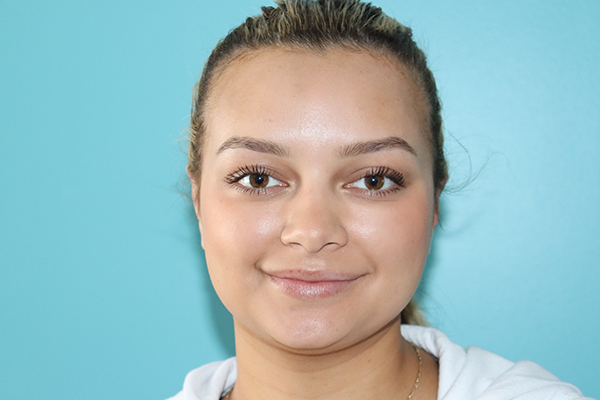 Ear Reshaping - Otoplasty