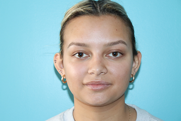 Ear Reshaping - Otoplasty