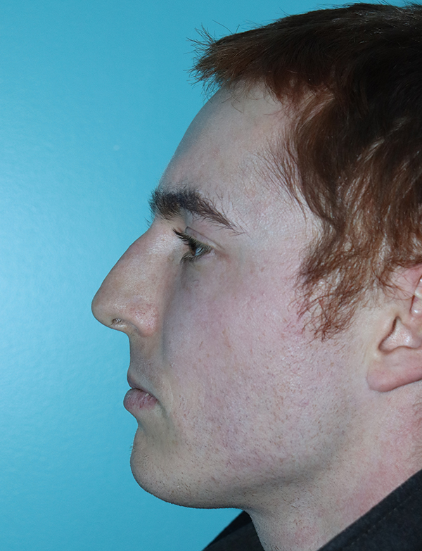 Rhinoplasty - Nasal Reshaping Case 46399 Before Photo Rhinoplasty - Nasal Reshaping