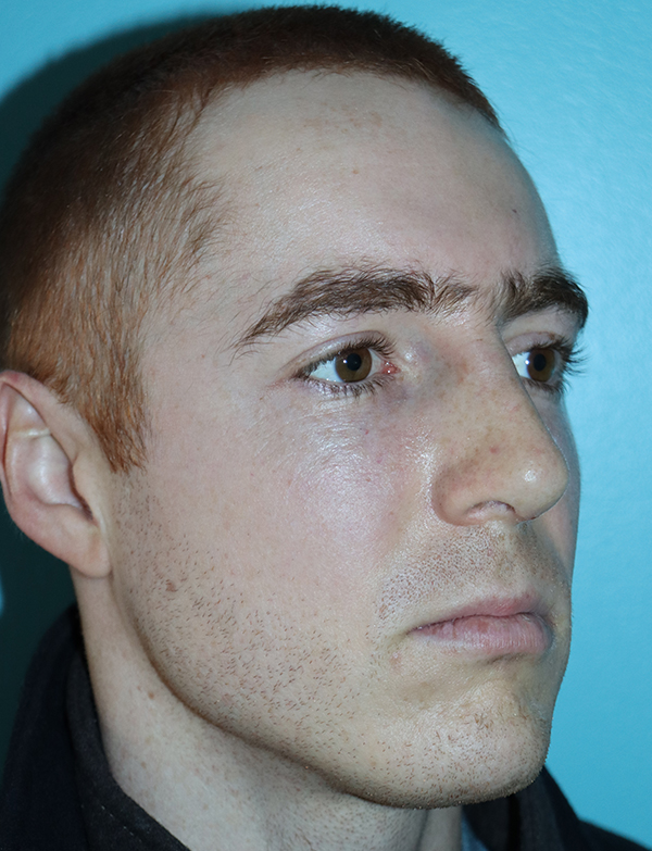 Rhinoplasty - Nasal Reshaping Case 46399 After Photo Rhinoplasty - Nasal Reshaping