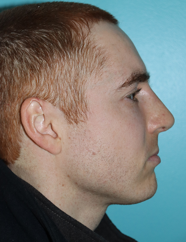 Rhinoplasty - Nasal Reshaping Case 46399 After Photo Rhinoplasty - Nasal Reshaping