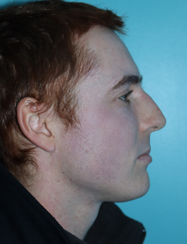 Rhinoplasty - Nasal Reshaping Case 46399 Before Photo Rhinoplasty - Nasal Reshaping