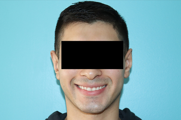 Ear Reshaping - Otoplasty