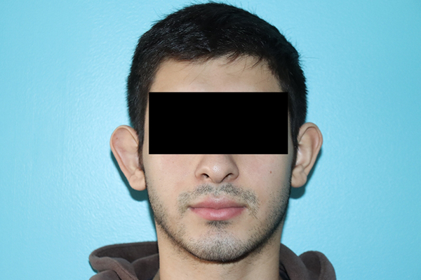 Ear Reshaping - Otoplasty